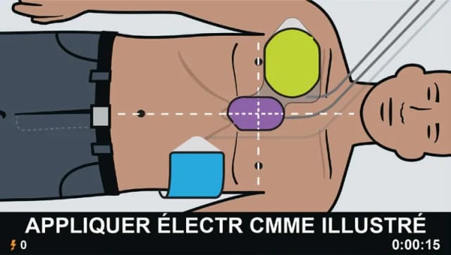 Diagramme de placement des électrodes